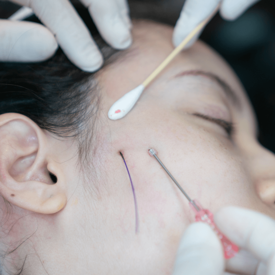 cheek thread lift